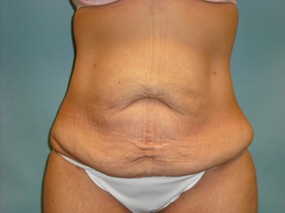 Tummy Tuck