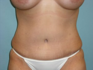 Tummy Tuck