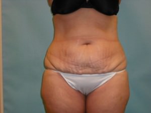 Tummy Tuck