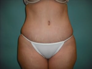 Tummy Tuck