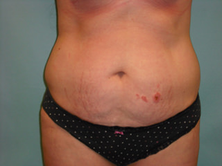 Tummy Tuck