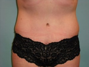 Tummy Tuck