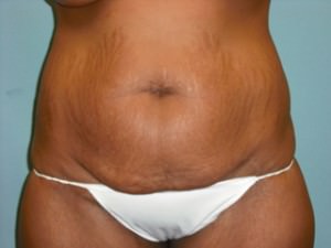 Tummy Tuck