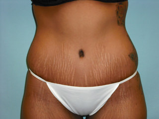 Tummy Tuck