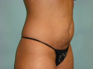 Tummy Tuck