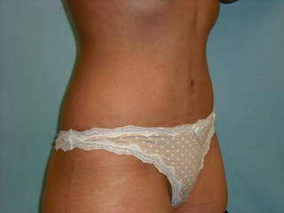 Tummy Tuck