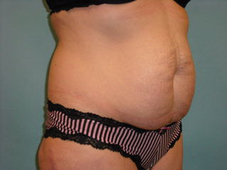 Tummy Tuck