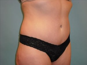 Tummy Tuck