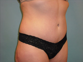 Tummy Tuck