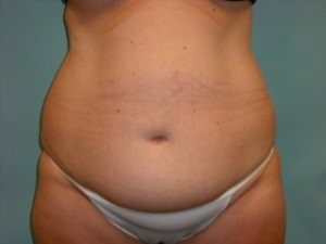 Tummy Tuck