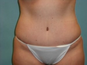 Tummy Tuck