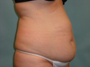 Tummy Tuck