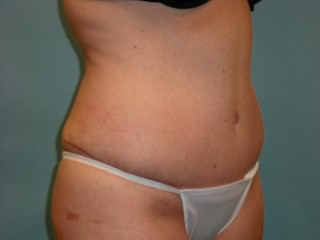 Tummy Tuck