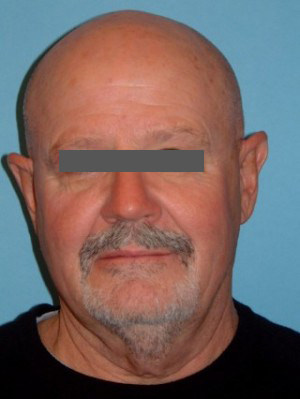 Before Image of Male Facelift Scottsdale Before Image of Male Facelift Scottsdale