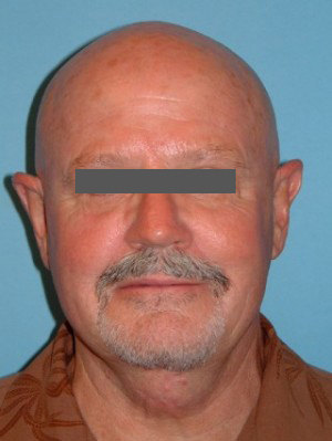 After Image of Male Facelift Scottsdale After Image of Male Facelift Scottsdale