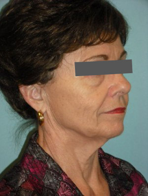 Facelift