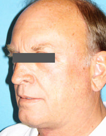 Neck Lift: Men