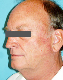 Neck Lift: Men