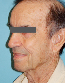 Neck Lift: Men