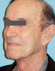 Neck Lift: Men