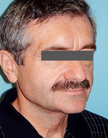 Neck Lift: Men