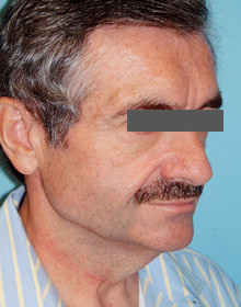 Neck Lift: Men