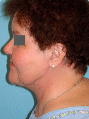 Neck Lift