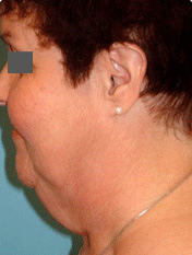 Neck Lift