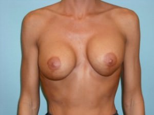 Breast Procedures