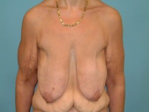 Breast Lift (Mastopexy)