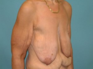 Breast Lift (Mastopexy)