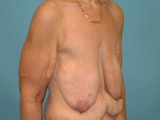 Breast Lift (Mastopexy)