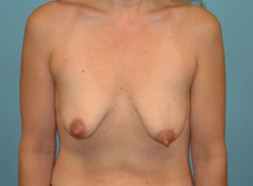 Breast Lift (Mastopexy)