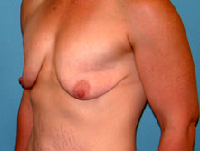 Breast Lift (Mastopexy)