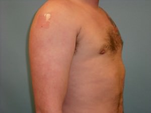 Male Breast Reduction - Gynecomastia