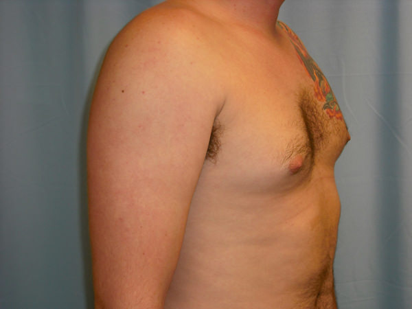 Male Breast Reduction - Gynecomastia