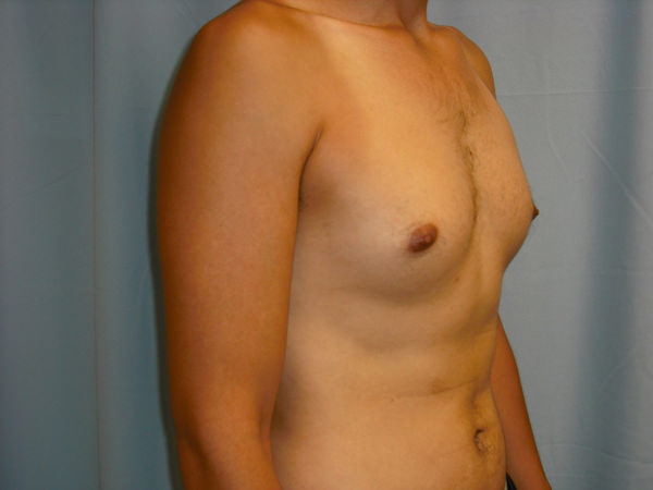 Male Breast Reduction - Gynecomastia