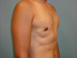 Male Breast Reduction - Gynecomastia