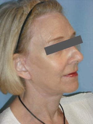 Facelift