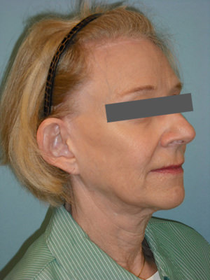 Facelift