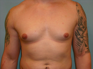 Male Breast Reduction - Gynecomastia