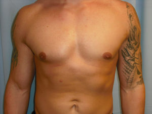 Male Breast Reduction - Gynecomastia