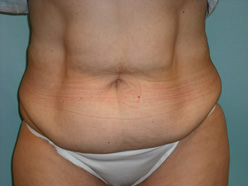 Tummy Tuck