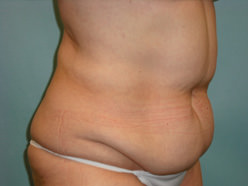 Tummy Tuck