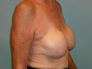 Breast Revision