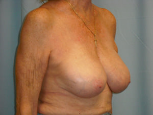 Breast Revision