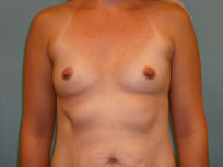 Breast Augmentation