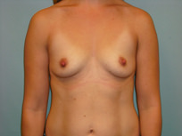 Breast Augmentation