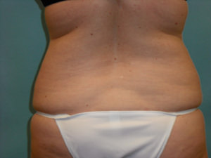 Liposuction