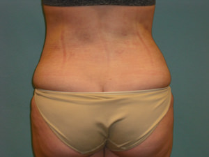 Liposuction